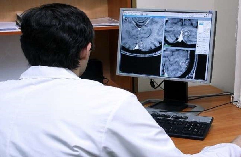 علامات خفية للجلطة الدماغية الدقيقة