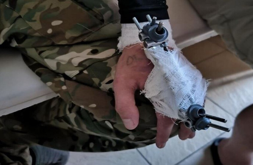 روسيا.. أجهزة مبتكرة لعلاج إصابات اليد