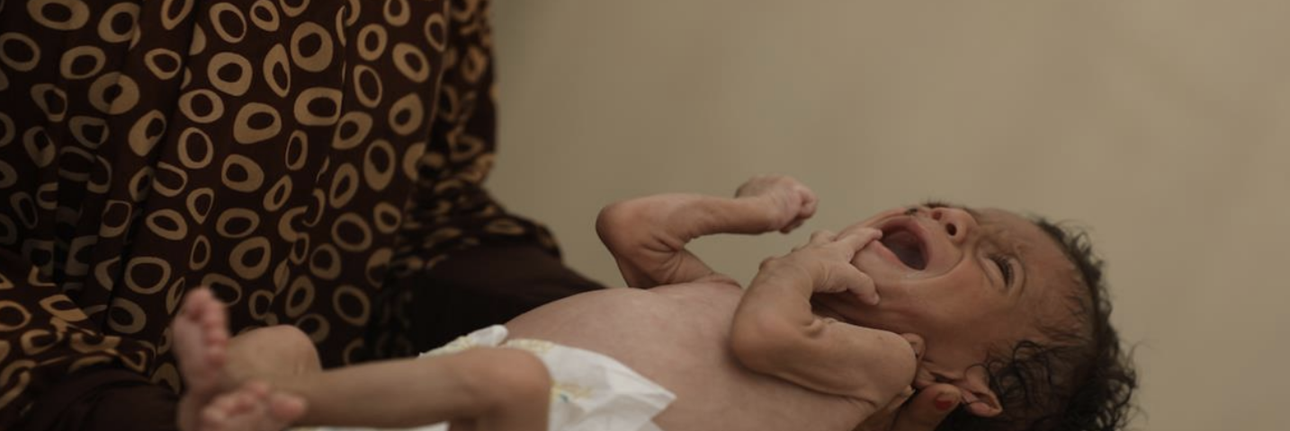 3 وفيات نتيجة المجاعة وسوء التغذية خلال الـ24 ساعة الماضية