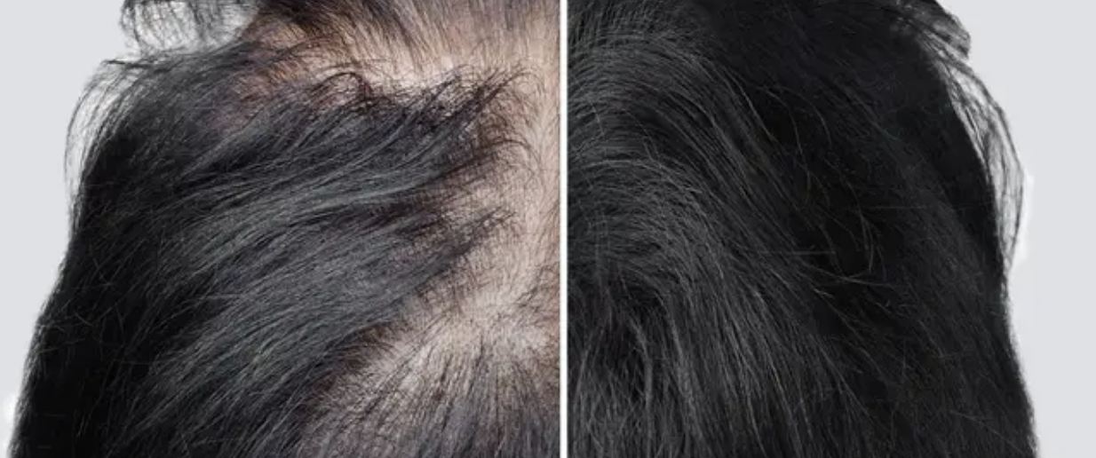 حل سحري للصلع الوراثي للرجال والنساء.. مستخلص من نبات ستيفيا