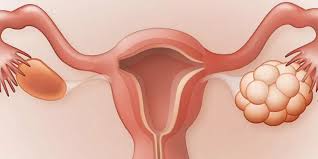 توابل المطبخ&hellip; سلاح داعم ضد تكيس المبايض