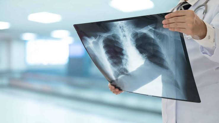 السكر يغذي أورام سرطان الرئة