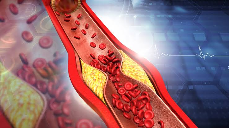 تصلب الشرايين.. العدو الصامت للقلب