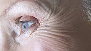 التجاعيد حول العين تكشف خطر الخرف