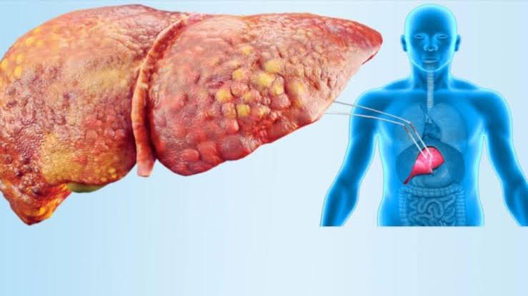 الفركتوز المصنع خطر خفي على الكبد