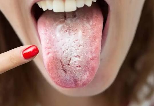 صور اللسان تكشف أسرار الصحة عبر الذكاء الاصطناعي