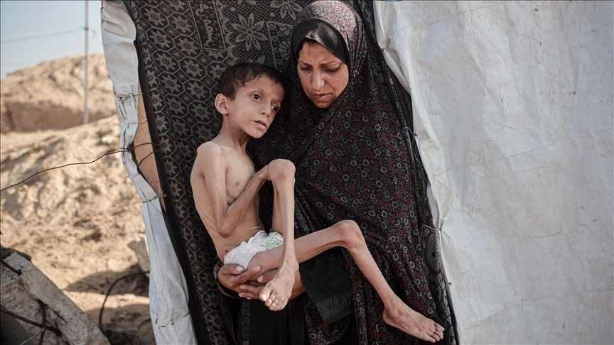 الأمم المتحدة: عدد حالات سوء التغذية الحاد بغزة ارتفع إلى 95 ألفا