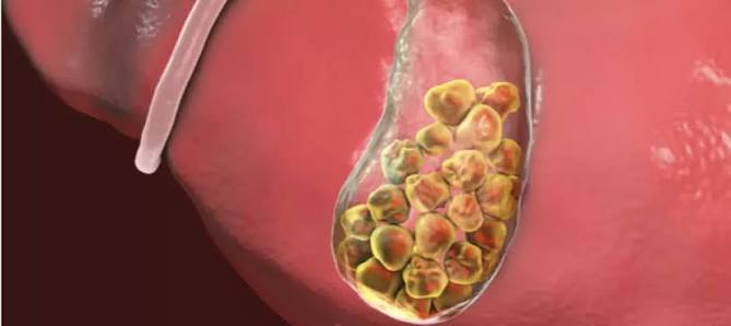 متى تحتاج لاستئصال المرارة