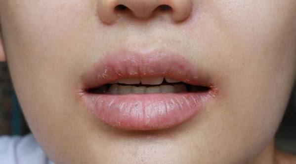 أسباب خفية وراء جفاف الفم