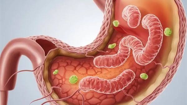 جرثومة المعدة.. العدوى الصامتة التي تهدد الصحة