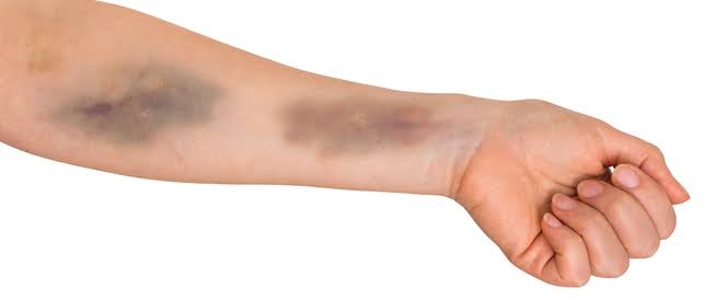 متى تصبح الكدمات غير المبررة سببًا للقلق