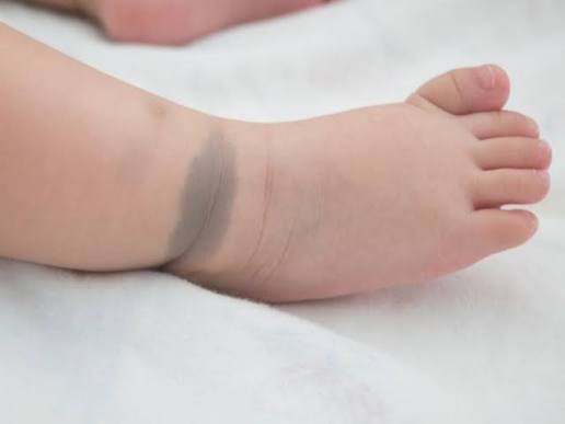 بقع الولادة عند الأطفال ليست دائمًا خطيرة