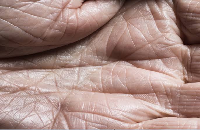 نمط شبكي على الجلد قد يكشف انسداد الشرايين