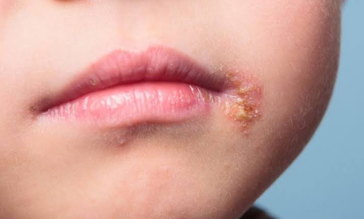 القوباء.. عدوى جلدية شائعة لكنها قابلة للعلاج