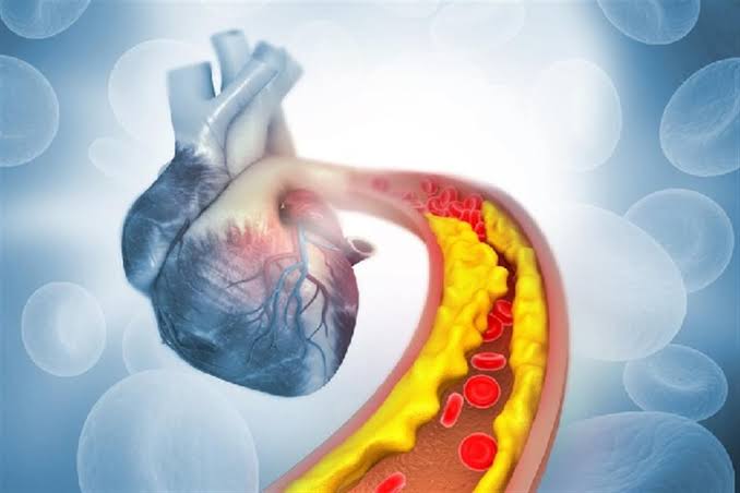 النحافة لا تحمي من انسداد الشرايين