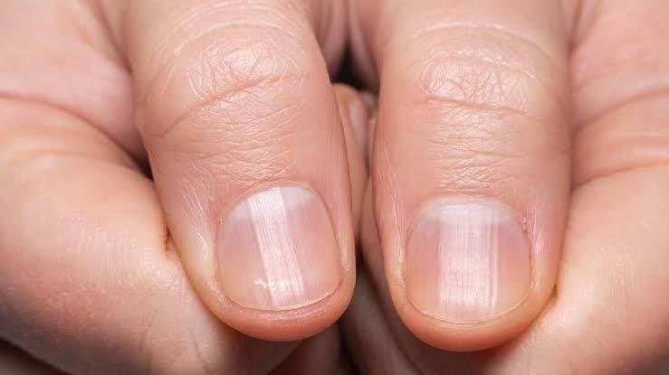 الأظافر تكشف أسرار القلب.. علامة لا تُهملها