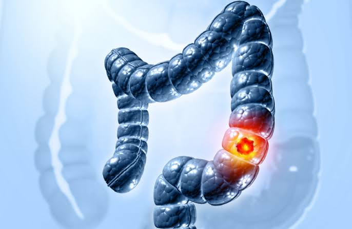 هل يشكّل بروتين NSMF مفتاحًا لعلاج سرطان القولون؟