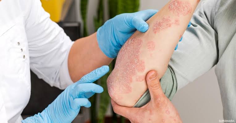 ما هي الأكزيما العصبية وكيف تُعالج؟