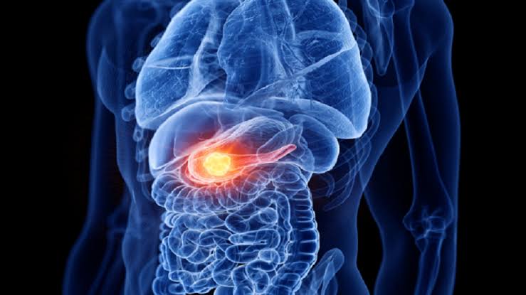 هل تكشف العلامة المبكرة سرّ سرطان البنكرياس؟