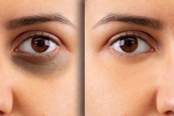 الكريمات وحدها لا تكفي لعلاج الهالات السوداء