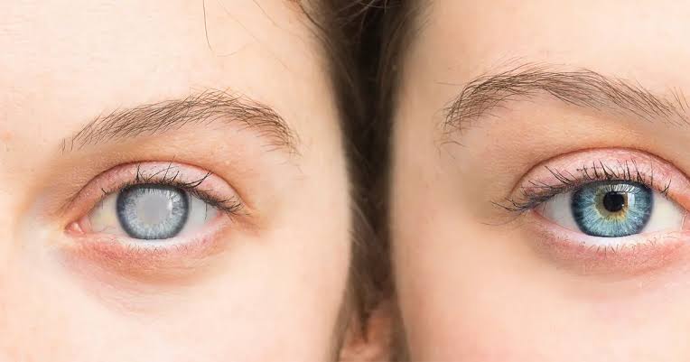 نتائج جديدة تفتح آفاق الوقاية من إعتام العين