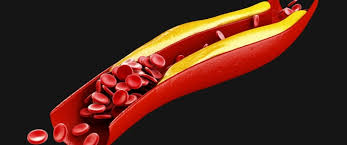 أسباب الكوليسترول المرتفع وطرق علاجه