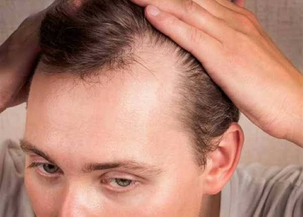زيوت طبيعية لتعزيز نمو الشعر للرجال ذوي فروة الرأس الدهنية
