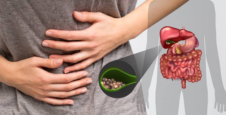 أطعمة قد تساعد على تقليل خطر حصوات المرارة